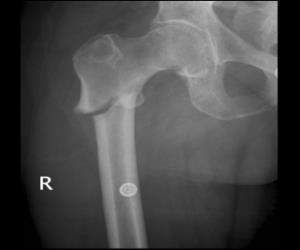 Tx is indicated if 10 year risk for hip fracture = 10% based on