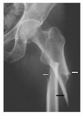 Atypical Femoral Fractures 3.