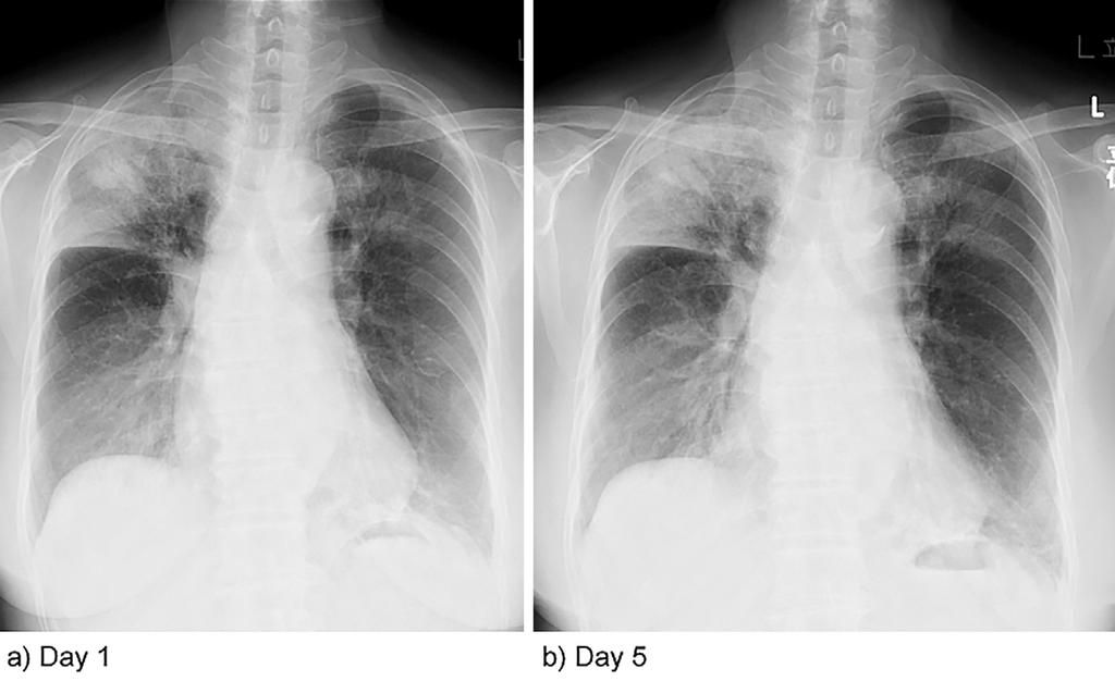 Figure 1. (a) Chest X-ray taken on Day 1 showing bilateral pulmonary infiltrates, especially in the right upper and right lower lung fields.