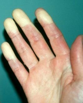 (50-80%) Arthritis (50-90%) Raynaud s