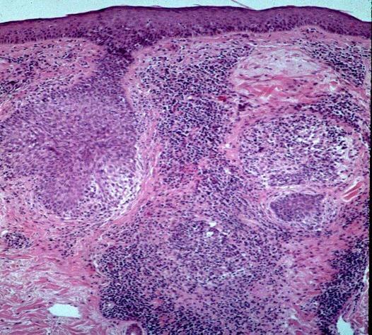 Mycosis Fungoides--