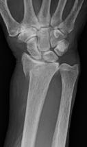 Unstable Radial Styloid