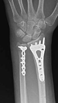 1 wk s/p injury ORIF radius and ulna Use external fixator for provisional reduction tool Summary ORIF DRFx 1. Preop C arm images 2. Know your implant system 3.