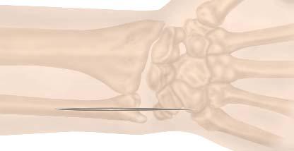 E-CENTRIX ULNAR HEAD REPLACEMENT SURGICAL TECHNIQUE STEP 1 With the forearm in pronation, an incision is made along the dorsoulnar aspect of the wrist centered over the distal radioulnar joint FIGURE