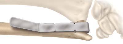 E-CENTRIX ULNAR HEAD REPLACEMENT RESECTION External Guide In a primary situation, use the external cutting guide (part # 25962200) to