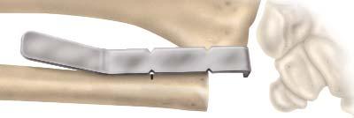 Place the guide end on top of the ulnar head and mark the resection with either a marking pen or bovie.