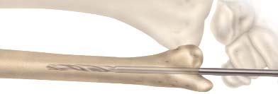 FIGURE 5 In a revision procedure or previously removed ulnar head, place the end of the cutting guide at the distal edge of the