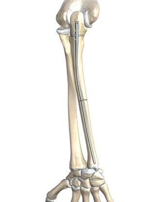 Verify in two directions that the rod has successfully crossed the fracture(s) and gained reduction. Check that the proximal end of the rod has been inserted below the surface of the bone.