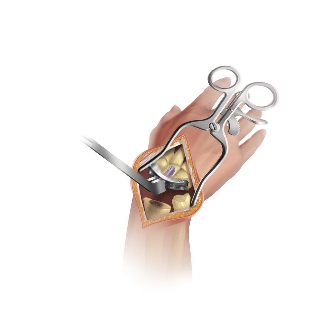 Figure 17 Figure 18 Carpal Trial Selection Remove the reamer and K-wire from the capitate.