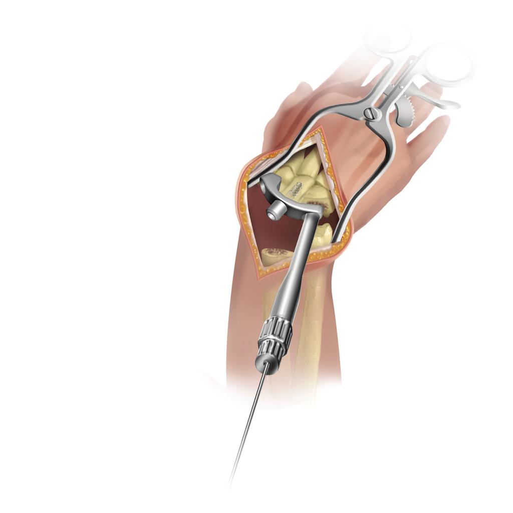 Maestro Wrist Radial Fracture System Figure 19a Figure 19 Figure 20 Carpal Implant Insertion Assemble the appropriate capitate stem