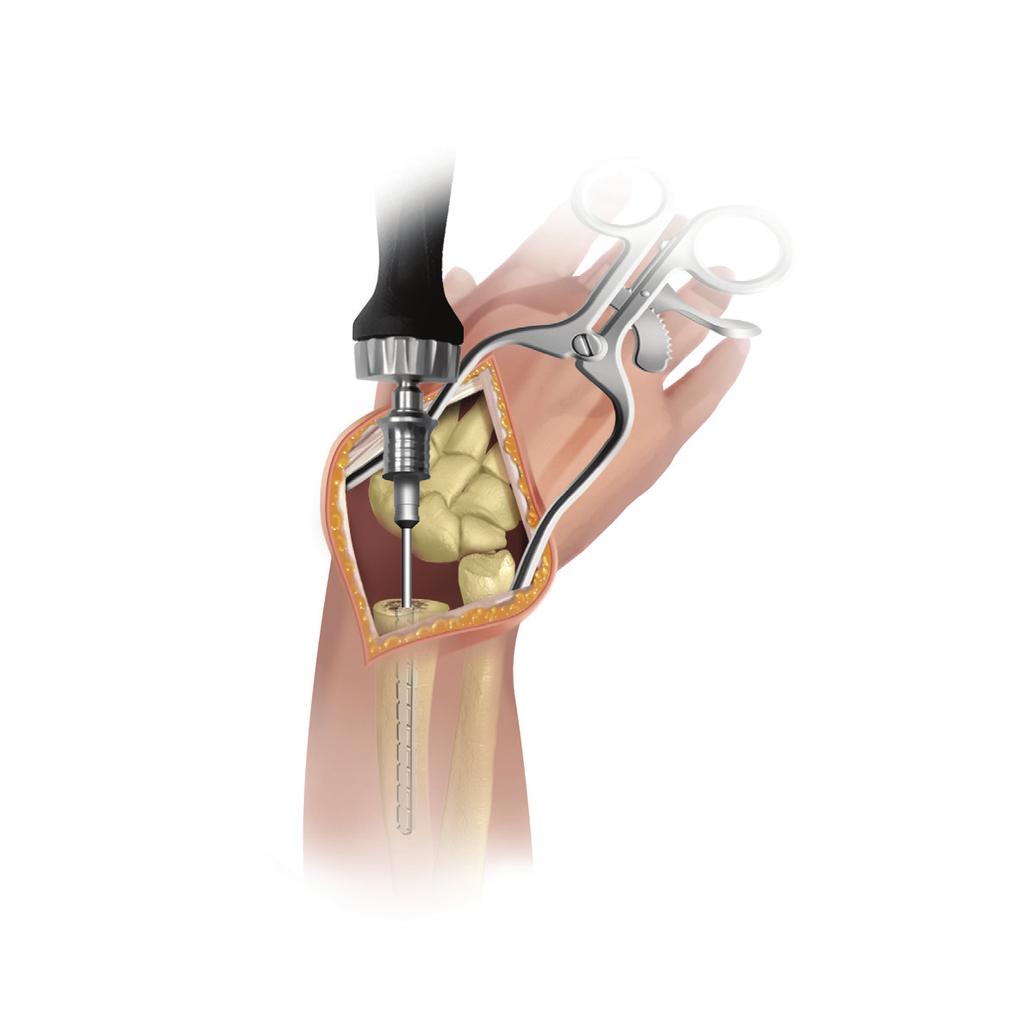 Maestro Wrist Radial Fracture System Figure 8 Figure 9 Note: It is preferred that the flange be placed in contact with the volar cortex of the radius and any gap that does exist be filled with
