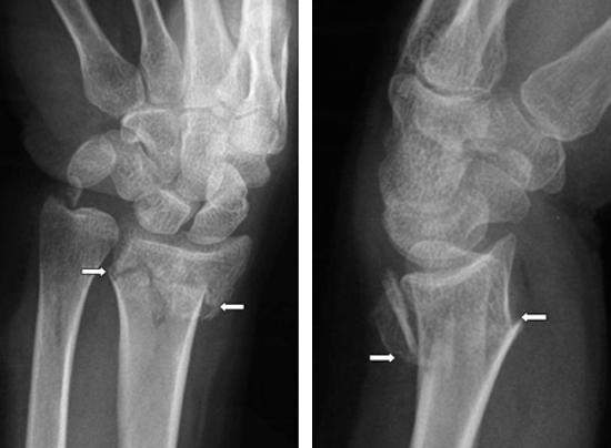 Distal Radius Fracture RED FLAGS RED FLAGS