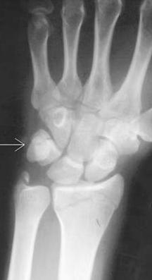 Triquetrium Pain ulnar sided and dorsal