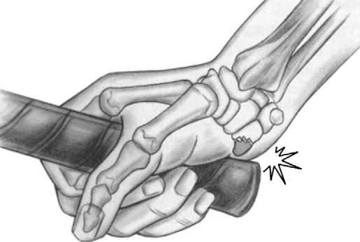 Hamate Pain ulnar sided and