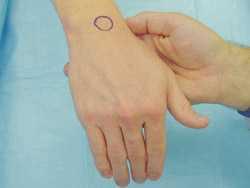 The Shuck Test for perilunate instability (Left) The wrist is held in flexion
