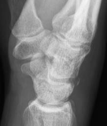 fracture Represent avulsion of the dorsal radiotriquetral ligament May