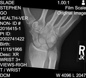 thumb spica 6wks to 20wks No return to play until fully healed on X-ray or CT scan Union