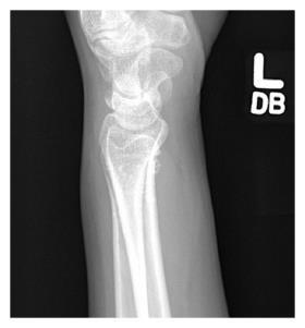 PERILUNATE DISLOCATION Most common carpal dislocations Common in men 20-30yrs Common mechanism is hyperextension, ulnar