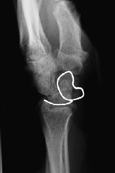 MVA, MCC, contact sports Rare in elderly b/c without good bone stock the distal radius fails before carpal bones or ligaments