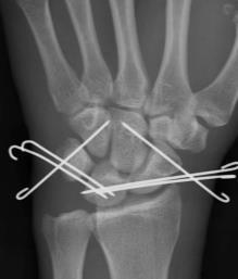 delayed/chronic injuries Xrays MANAGEMENT Urgent reduction and splinting
