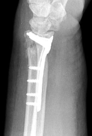 Note: SP series screws are not intended to provide subchondral support and use should be limited to capture of remote bone fragments where partially threaded pegs cannot be used.