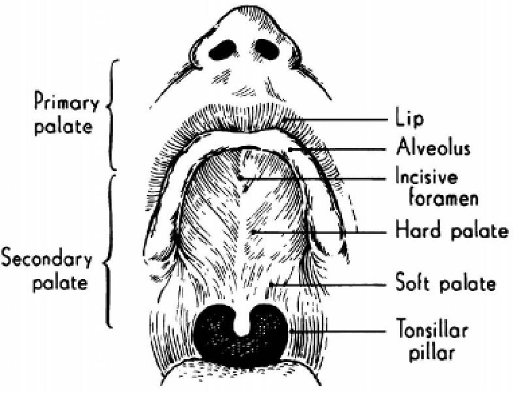 CHAPTER 10 CLEFT LIP AND PALATE Chen Yan, MD and Sanjay Naran, MD I. ANATOMY AND DEFINITIONS A. Cleft Lip (CL) alone, Cleft Lip with Cleft Palate (CLP), and Cleft Palate (CP) alone 1.