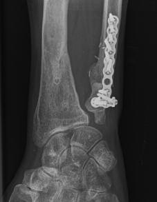 The patient with the failed Sauvé Kapandji had good reconstruction of the distal ulna.