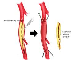 Surgical treatment of lower limb ischaemia There are broadly two types of surgery that can improve the blood supply to the leg; endarterectomy and bypass surgery.