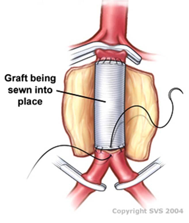 35081 Direct repair of aneurysm, pseudoaneurysm, or excision (partial or total) and graft insertion, with