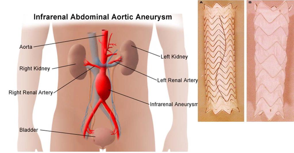 34800 Endovascular repair of infrarenal abdominal aortic