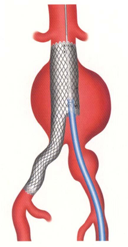 34802 Endovascular repair of infrarenal abdominal aortic aneurysm
