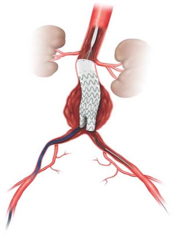 aneurysm or dissection; using