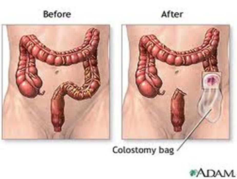 44143 Colectomy, partial; with end colostomy and closure of