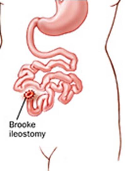 with ileostomy or ileoproctostomy