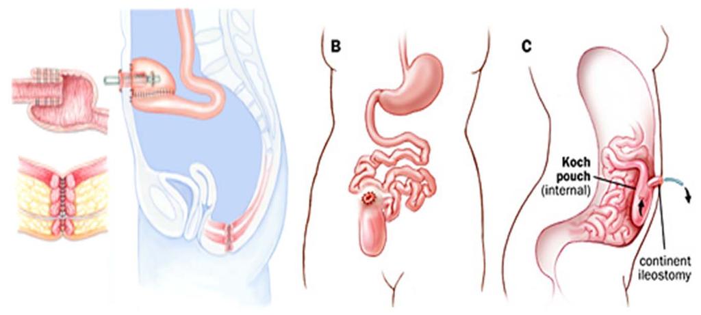 44151 Colectomy, total, abdominal,