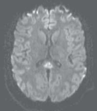 can indicate diffuse axonal injury