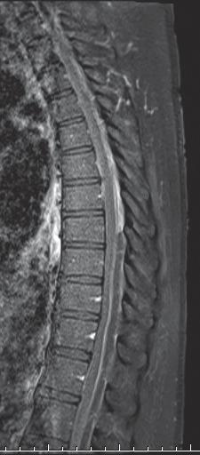 DWI Spine: Infection Is this fluid an abscess?