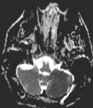 location of an acute infarct before any other MRI sequence