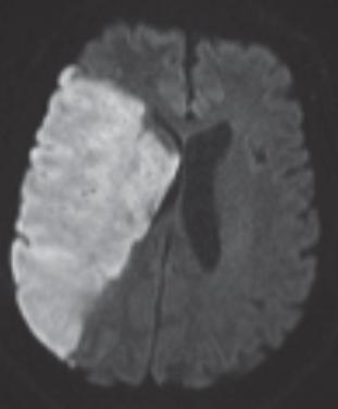 diagnose/confirm presence or absence of acute stroke after a