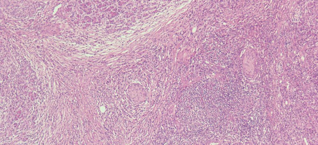positive for anti-igg4 antibody (Fig.5). The pancreatic duct is narrowed by periductal fibrosis and lymphoplasmacytic infiltration.
