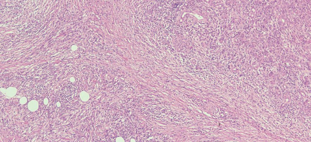 5 Immunohistochemical finding of AIP, showing abundant infiltration of IgG4-positive plasma cells in the pancreas (IgG4-immunostaining). Fig.