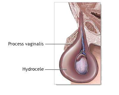 Patient Information Department of Urology 39/Urol_04_11 Surgery for a congenital hydrocele/hernia: procedure-specific information What is the evidence base for this information?