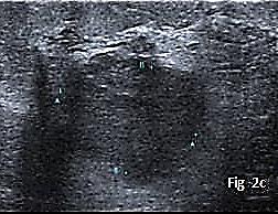 Case 2 A 54-year-old lady presented with a lump in the right breast for past three months. The lump was static in size, not associated with pain, nipple discharge.