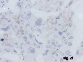 Microscopically, Nottingham histologic score was grade -3 squamous cell carcinomas (metaplastic carcinoma).
