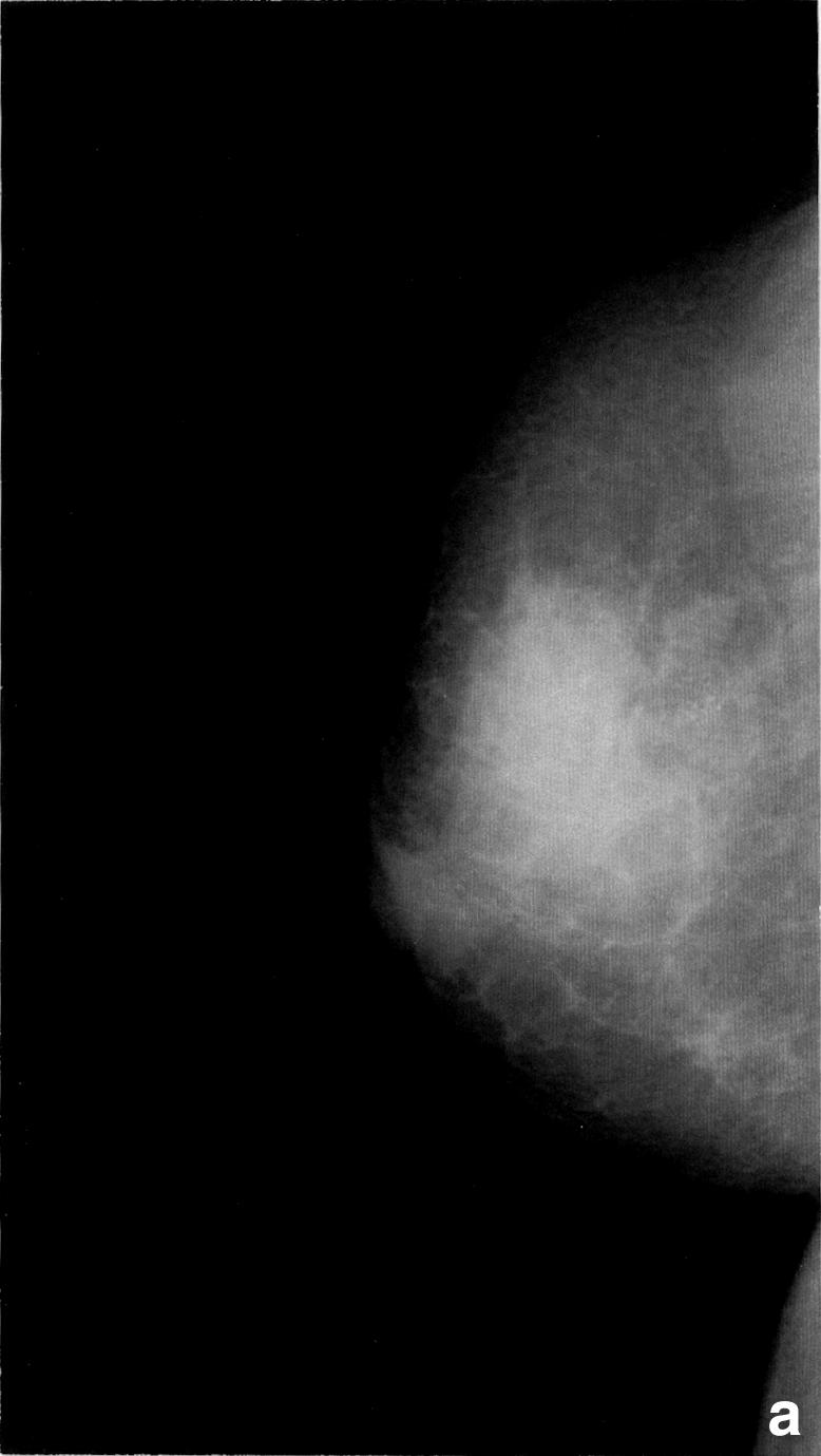 456 Neoadjuvant chemotherapy for breast cancer Figure 2. Case 3: a 67-year-old postmenopausal woman presented with a right primary breast carcinoma (T3N0M0).