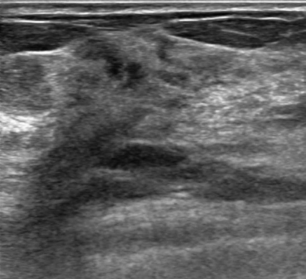 B, C. A dynamic contrast-enhanced and subtracted T1-weighted image shows incidental non-mass enhancement in the lower outer quadrant of her right