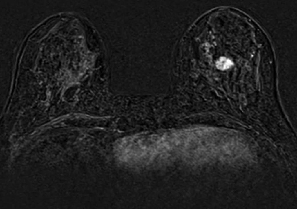 Other breast landmarks, such as subcutaneous fat, glandular tissue, and subglandular fat, are also helpful in translating information from MRI to US.