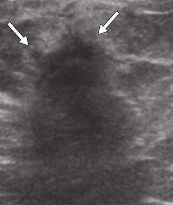 receptor 2 so-called triple receptor negative cancer. A, Mammogram shows irregular mass with spiculated margins without calcifications (arrows).