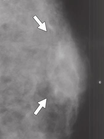 Mammogram shows round mass with microlobulated margins (arrows). datasets.