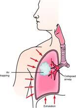 COPD Emphysema Disease caused by